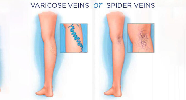 Varicose veins