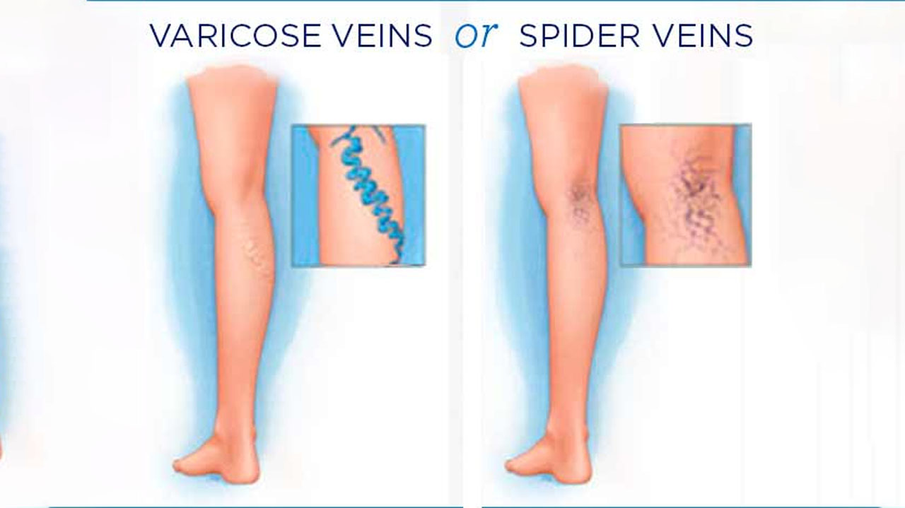 Varicose veins