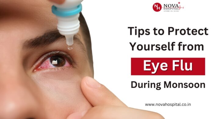 Tips To Protect Yourself from Eye Flu This Monsoon